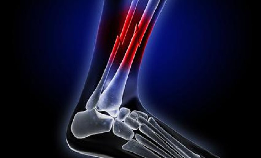 FRACTURA
