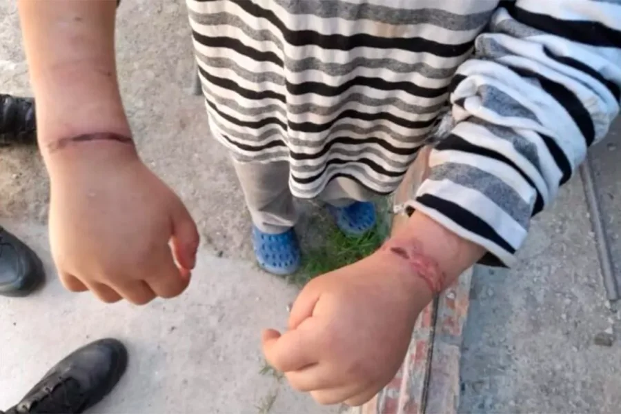 IMAGEN INTERNET. LESIONES. Fueron causadas por ataduras impuestas por su madre.
