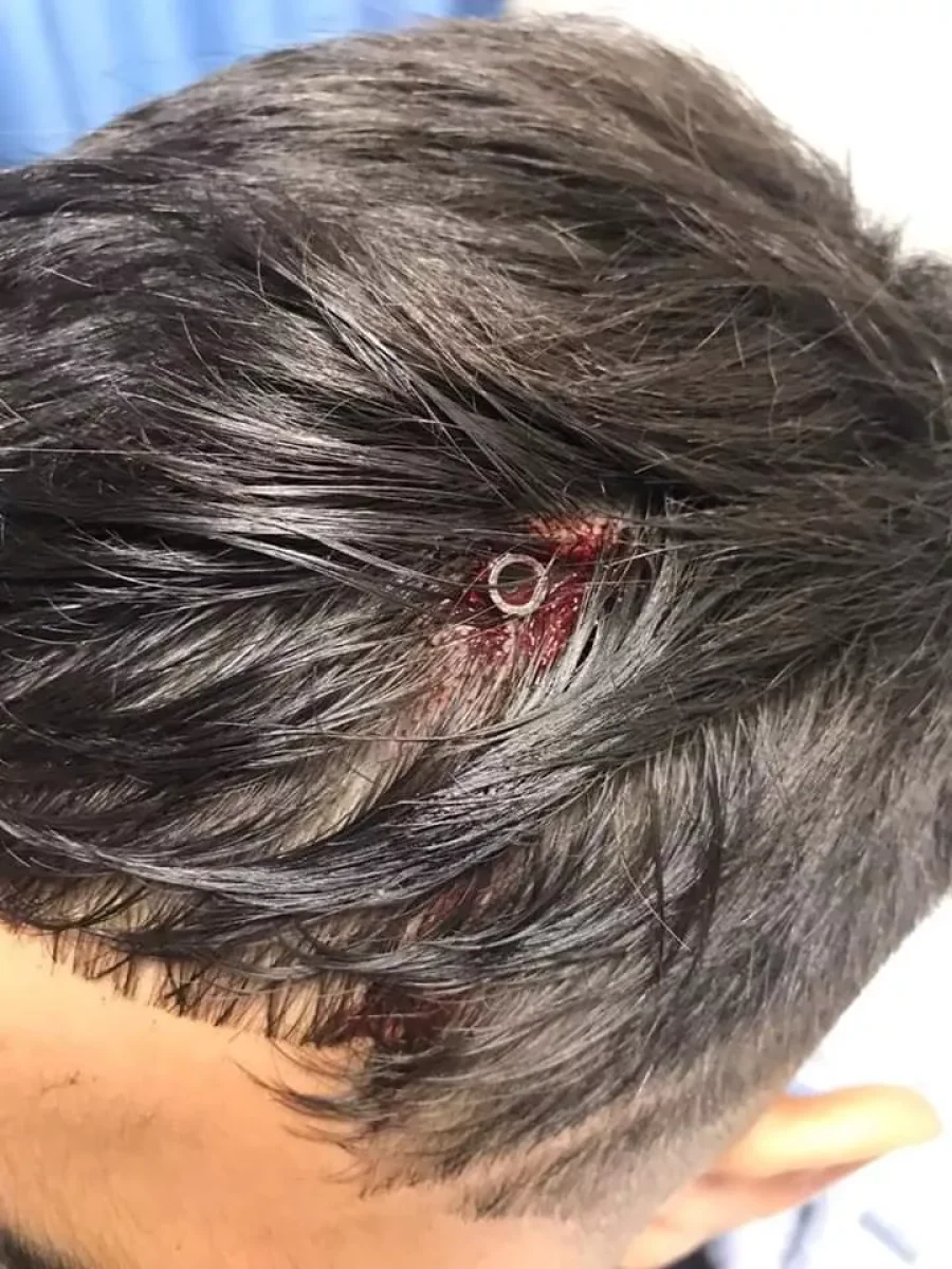 IMAGEN ARCHIVO. LESION EN LA CABEZA.  Una situaci&oacute;n de este tipo, sufri&oacute; un joven en un robo.