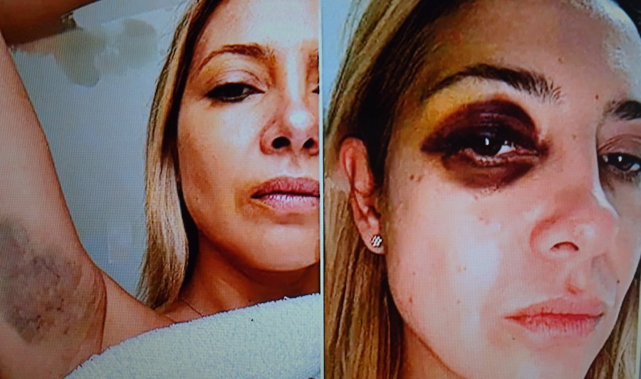 MARCAS. Fabiola Y&aacute;&ntilde;ez con un ojo golpeado, una de las fotos que forma parte de la denuncia contra Alberto Fern&aacute;ndez.