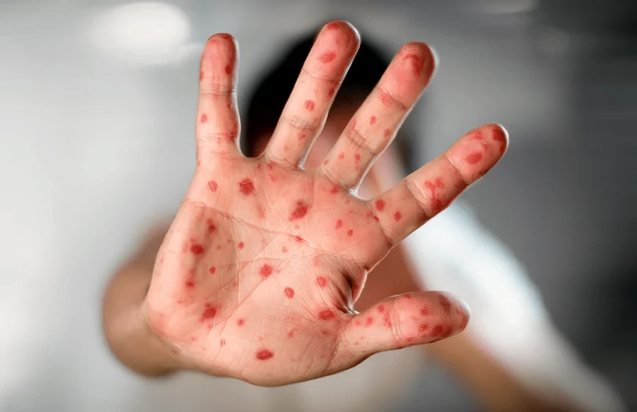 Mpox, emergencia de Salud P&uacute;blica.