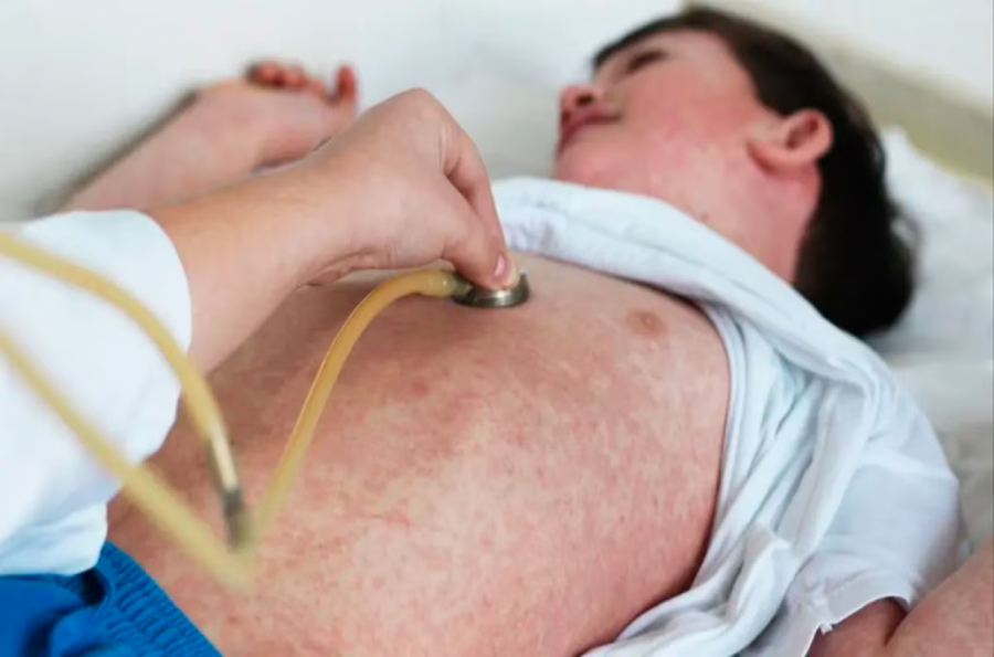 A ESTAR ALERTAS. En las &uacute;ltimas semanas han aumentado los casos de sarampi&oacute;n en el pa&iacute;s.