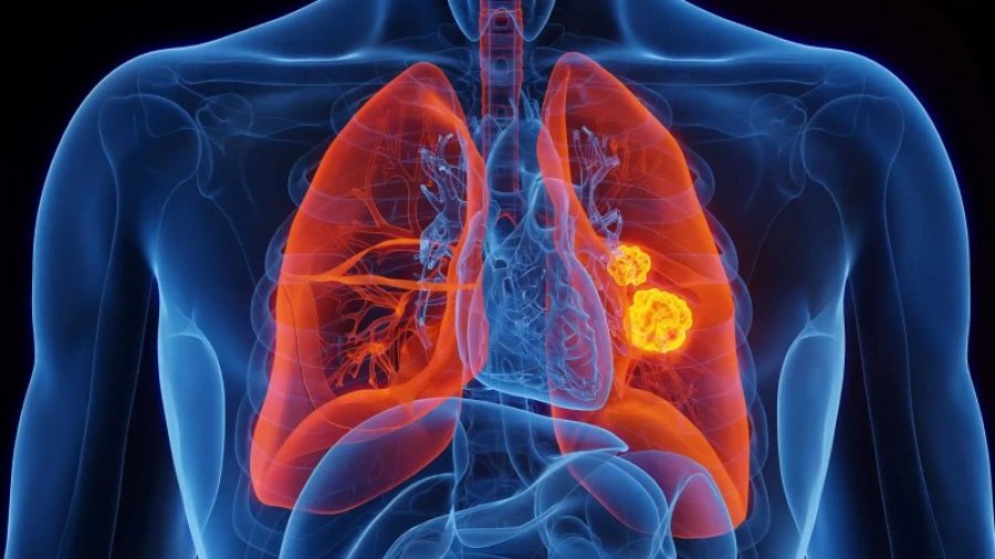 Claves para detectar a tiempo el c&aacute;ncer m&aacute;s mortal en la Argentina.