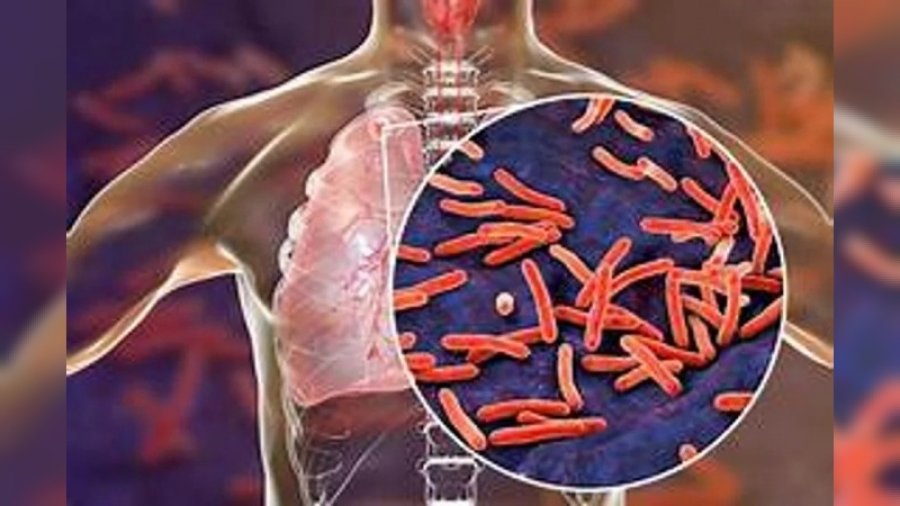 INFECCIONES. Fuerte preocupaci&oacute;n por el crecimiento de los casos de una enfermedad respiratoria en el pa&iacute;s.