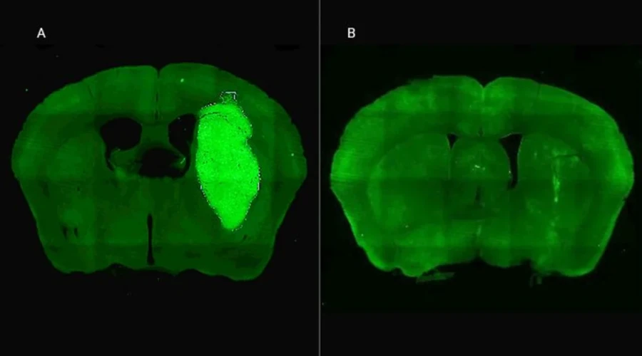 A) Se visualiza el tumor cerebral en un modelo precl&iacute;nico. B) El tumor desaparece gracias a la administraci&oacute;n de la estrategia terap&eacute;utica dise&ntilde;ada por los especialistas del CONICET.