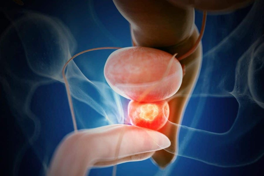 TUMOR MORTAL. El c&aacute;ncer de pr&oacute;stata es el m&aacute;s prevalente diagnosticado en el hombre.